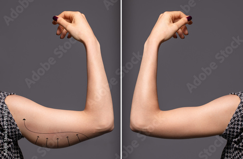 Cuadros en Lienzo Woman arms with bat wings, comparison between before and after brachioplasty sur