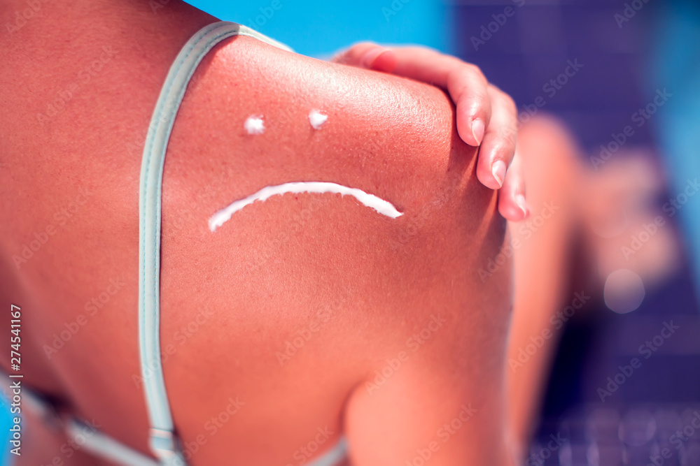 Woman with sun protection cream on her burned skin in the shape of sad smile. Summer, healthcare and vacation concept - obrazy, fototapety, plakaty 