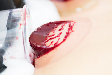 Close up of young person doing hijama treatment. Blood cleaning process.