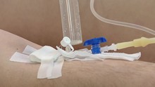 Hand Of A Patient With An Infusion Catheter.  Patient Treatment At Inpatient Unit In Hospital By Infusions Intravenous Therapy Via Peripheral Intravenous Catheter.