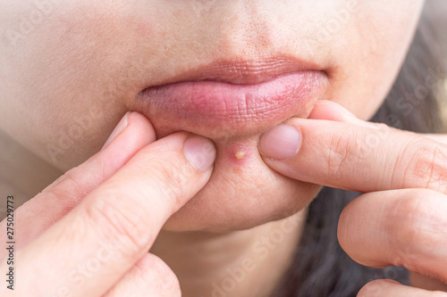 Acne Pimple Under Lips And Chin In Asian Woman Skin Face Close Up