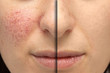 © Alessandro Grandini - A close up view on the cheeks of a young Caucasian woman suffering from rosacea. Before and after laser surgery to remove the blemishes.