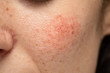 A close-up view on the cheek of a young Caucasian lady with a blotchy red cheek. A common symptom of rosacea and dermatitis in young adults.