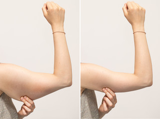 A split screen of a woman pinching the skin beneath her arm. Showing the before and after results of brachioplasty surgery, also called an arm lift.