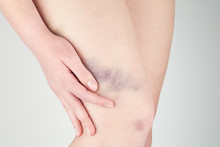  Bruises On The Girl's Legs