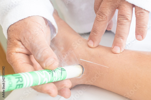 Fotomural Woman being treated with acupuncture and moxibustion treatments.