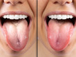 A before and after view of on the tongue of a Caucasian girl, she sticks her tongue out to reveal oral thrush on the left. Then on the right she is free from the fungal infection.