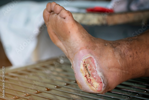 Infected diabetic foot ulcer,selective focus Billede på lærred