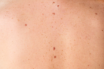 close up detail of the bare skin on a man back with scattered moles and freckles. checking benign mo