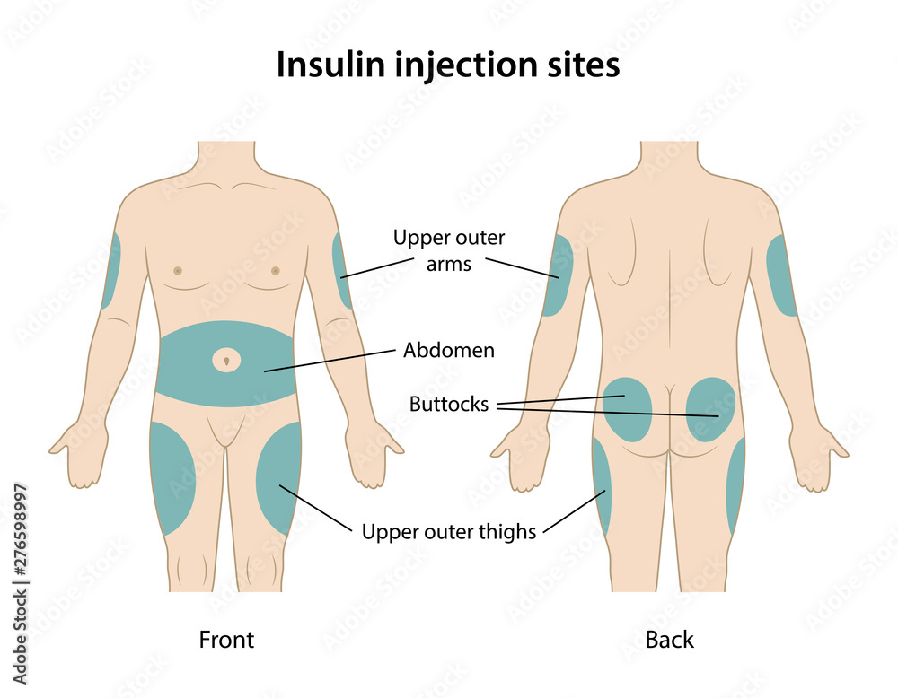 Diabetes. Insulin injection sites shown on the body: upper outer arms ...
