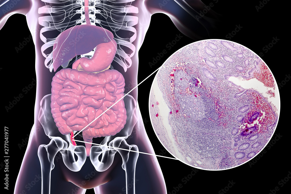Chronic appendicitis, 3D illustration of human body with inflammed ...