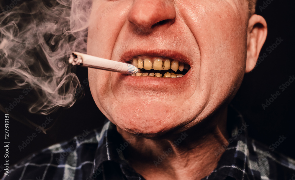 cigarette smile Cigarette in the man's mouth. Plaque teeth cavities and paradontosis.  Smoking causes dental decay problems and bad smile. Dentist treatment  concept. Harmful habit. Stock Photo