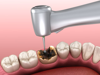 Caries removing process. Medically accurate tooth 3D illustration.