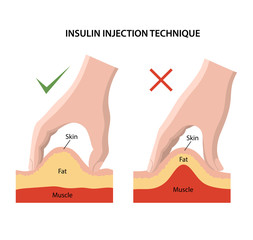 Canvas Print - Insulin injection technique for diabetes. Correct and incorrect injections are shown. Anatomical vector illustration in flat style isolated over white background.