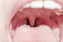 Larynx Throat Glands Tongue Viral Lingitis Inflammation Of Tonsils Mouth For Medicine