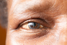 An Extreme Closeup View On The Open Eye Of An Older African Man With A Cataract. A White Cloudy Disc Is Seen In The Iris, With Room For Copy.