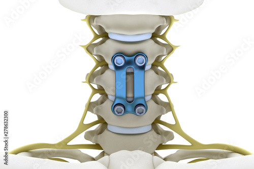 Fotografía Cervical vertebrae fixed with a metal plate and screws