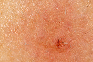 little wound on human skin