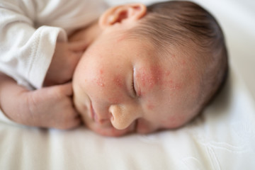 newborn skin acne 