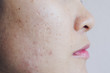 © boyloso - Close up of Asian woman face has problems with skin on her face. Problems with acne and scar on the female skin.