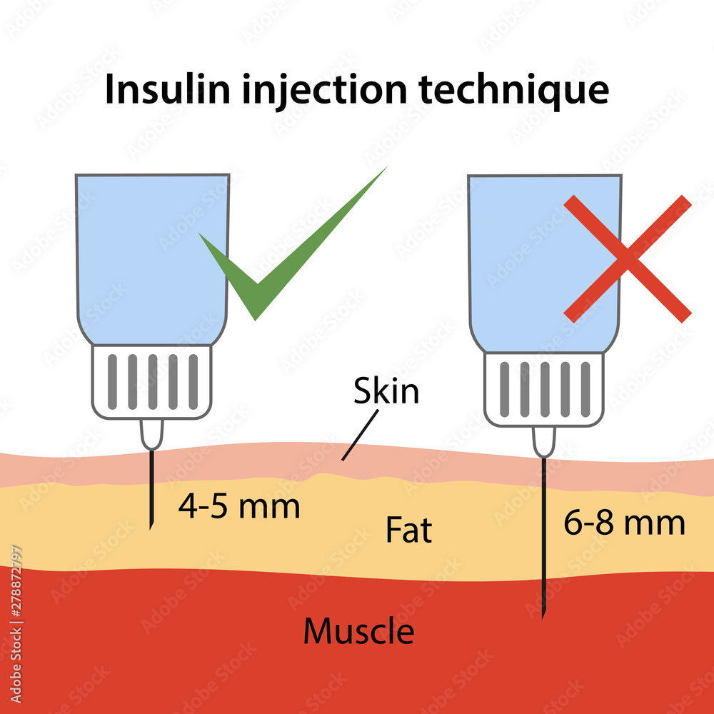 Insulin injection technique for diabetes. Correct and incorrect ...