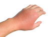Inflammation, swelling, redness of the hand shows infection. Insect bites. Cellulitis at left hand isolated on white background.