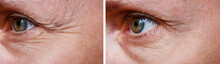 Procedure For The Rejuvenation Of Wrinkles Around The Eyes, Crow's Feet,  Before And After Effect