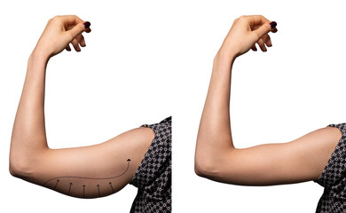 Arrows show the before and after results of a successful brachioplasty, a surgical procedure to remove excess fat in the upper arms. Isolated on white backdrop.