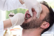Biały mężczyzna siedzi na fotelu dentystycznym z szeroko otwartymi ustami. Dłonie stomatologa w białych rękawiczkach chwytają zęba kleszczami. Ekstrakcja zęba u białego mężczyzny. 