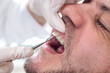Końcówka ekskawatora dotyka szczeliny między zębowej podczas przeglądu zębów u stomatologa. Twarz białego mężczyzny z lekkim zarostem leży na fotelu podczas badania. 