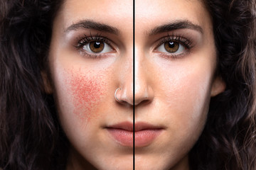 An extreme close up portrait of a beautiful Caucasian girl in her early twenties. Showing the before and after results of a successful procedure to remove dilated blood vessels in her cheeks.