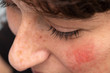 © Alessandro Grandini - A high angled view on the face of a young Caucasian woman with rosy red cheeks. Symptomatic of rosacea, a common skin complaint in young adults.