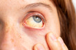 © Alessandro Grandini - An extreme closeup view on the face of a young Caucasian woman. She pulls cheek down and looks towards sky to reveal yellowing of the eyeballs. A common symptom of liver failure and serious diseases.