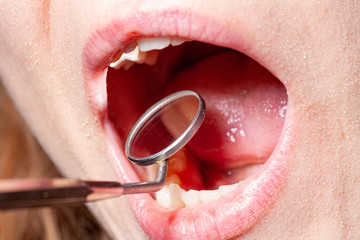 temporary filling of a tooth caries patient