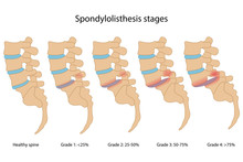 Spondylolisthesis Stages With Main Description. Healthy Spine And Spine With Spondylolisthesis In Lateral View Are Isolated On White Background. Vector Illustration In Flat Style