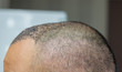 Top view of a man's head with hair transplant surgery. Bald head of hair loss treatment
