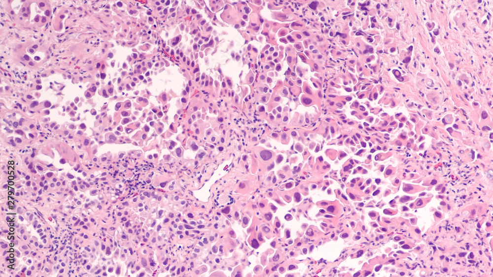 Lung cancer - adenocarcinoma: Therapies for specific genetic mutations (biomarkers EGFR, ALK, ROS1, BRAF, PDL1, KRAS) are appropriate for selected cases. - obrazy, fototapety, plakaty 