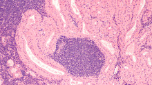 Microscopic Image Of A Warthin's Tumor, A Benign Tumor Of The Salivary Gland.