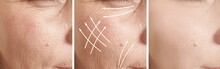 Woman Wrinkles Face Before And After Treatment, Arrow,