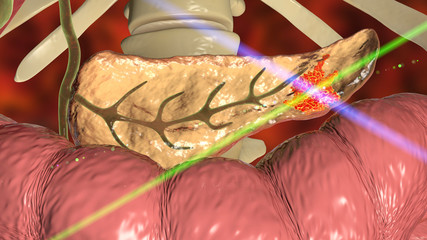 Sticker - Pancreatic cancer, malignant tumor of pancreas, 3D illustration