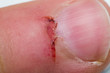 © Todorean Gabriel - wound by cutting near the nail
