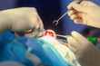 © satyrenko - Surgeon and his assistant performing cosmetic surgery on nose in hospital operating room. Nose reshaping, augmentation. Rhinoplasty.