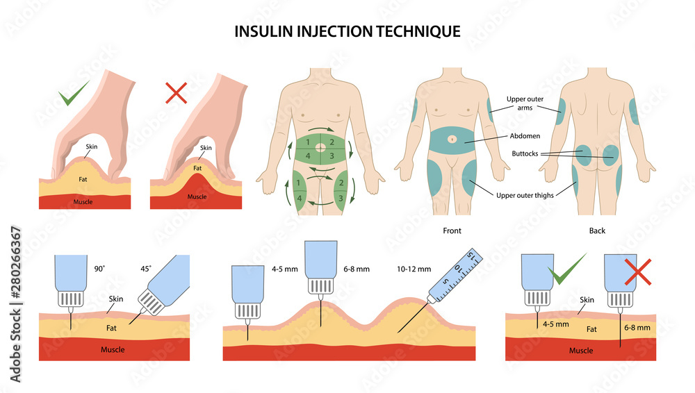 Set of images of insulin injection technique in diabetes: correct and incorrect injections depending on length of needle, insulin injection sites and sequence of injection sites. Vector illustration. - obrazy, fototapety, plakaty 