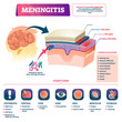 Meningitis vector illustration. Labeled brain membrane inflammation scheme.