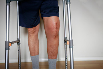 Man with walker after knee replacement surgery, stitches close up. Painful scar after knee surgery