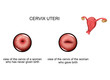 cervix before and after childbirth