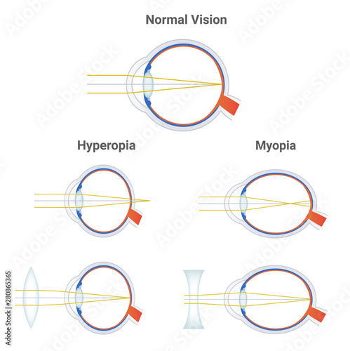 myopia hyperopia lenses)