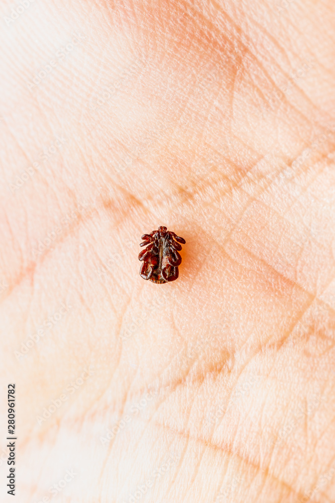 Photo Stock Encephalitis Insect Tick on Hand. Encephalitis Virus or ...