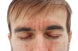 © Den - head of sick man with closed eyes with red allergic reaction on skin, redness and peeling psoriasis on nose, forehead and cheeks, seasonal skin problem, close-up, white background