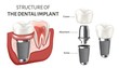 Educational poster showing a structure of the dental implant. Vector illustration isolated on the white background.